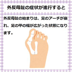 外反母趾の症状が進行すると　足に合わない靴を履き続けると、体の様々な箇所に負担がかかり、足だけでなく、目、首、腰なども不調をきたします。足に合わない靴を履くことで起こる体の不調《靴擦れ、外反母趾、むくみ、偏平足、腰痛、猫背、肩こり、疲れ目》